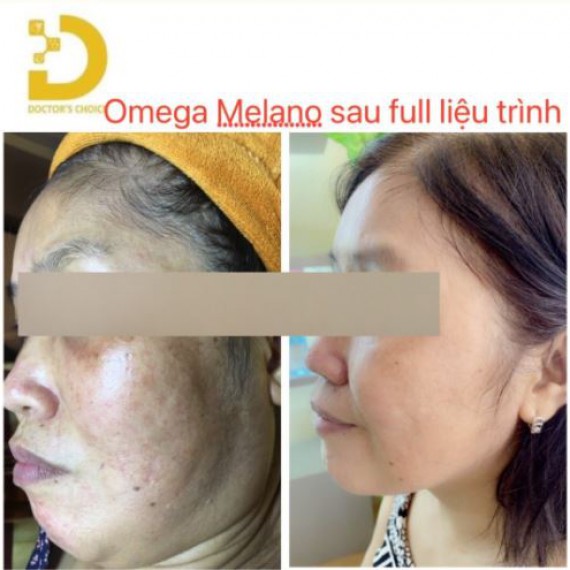 Kết quả điều trị Omega Melano sau khi sử dụng full liêu trình - Chị Ly