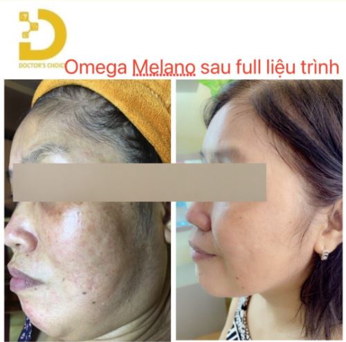 OMEGA MELANO FULL LIEU TRINH - CHI LAN